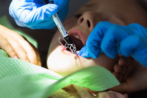 Implants dentaires trouver un implantalogue Reunion de confiance
