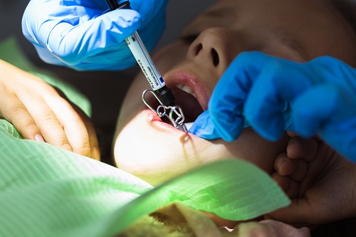 Implants dentaires trouver un implantalogue Reunion de confiance
